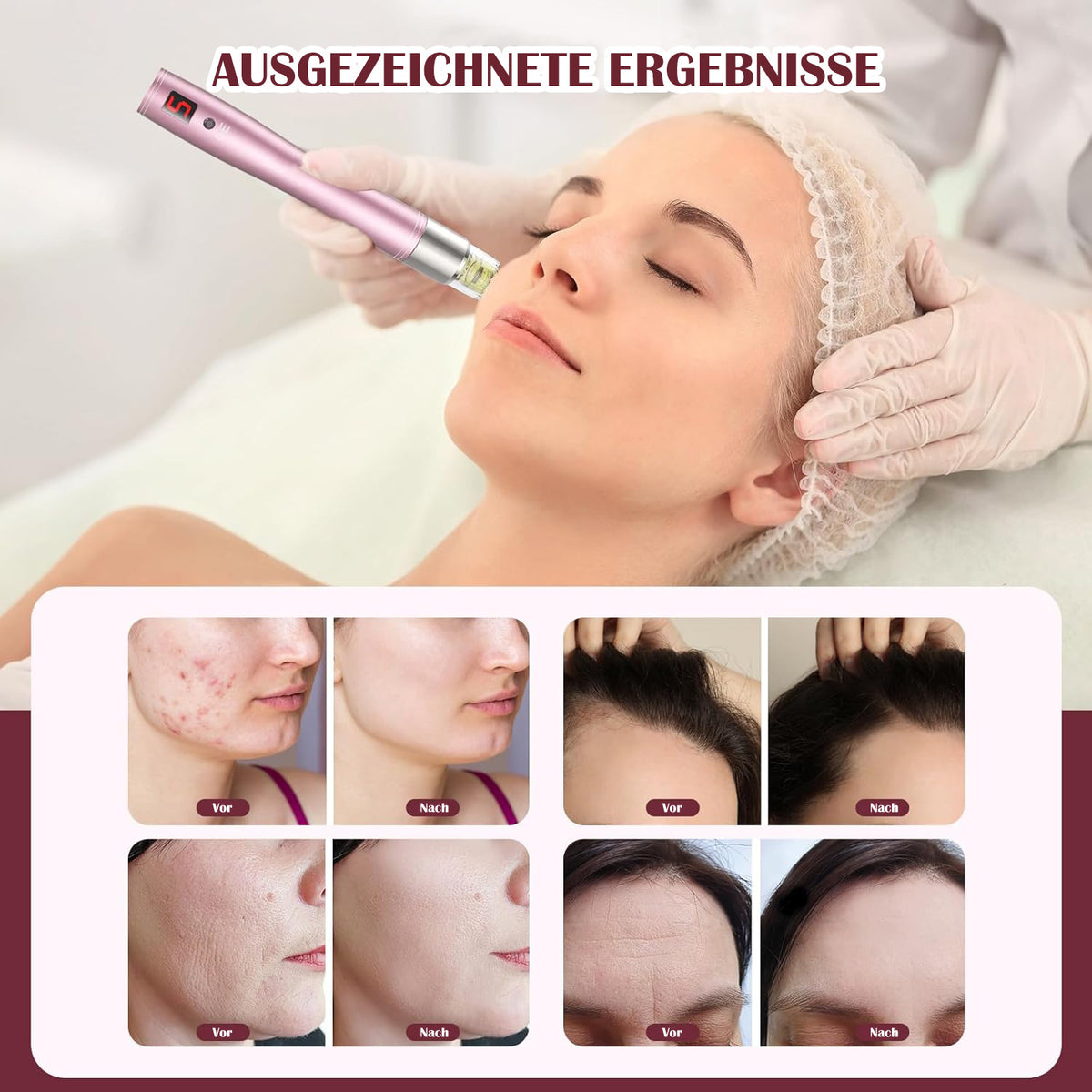 Cool-i ® Microneedling Pen mit Serum-Auftrag – Kabelloser, 5 Stufen Serum gleichmäßig auf Gesicht und Körper auftragen.A3