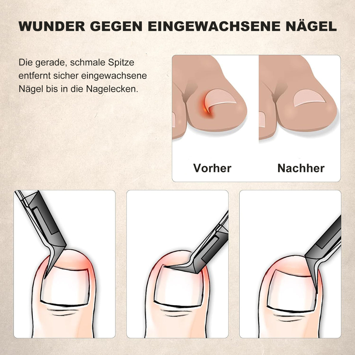 Profi Nagelzange aus Edelstahl – Präzisions-Fußnagelschere für eingewachsene Zehennägel mit rutschfestem Griff