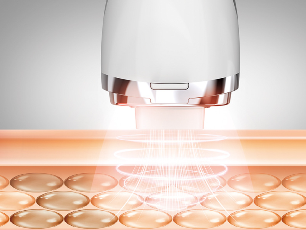 COOL-i® RF Gerät: Tiefenwirksame Radiofrequenz-Technologie -  Die Grafik zeigt, wie die RF-Energie in die Hautschichten eindringt und die Kollagenproduktion anregt.